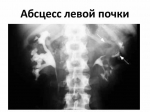 Врачи в Люберцах успешно вылечили ребёнка от абсцесса почки